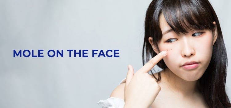 mole on the face